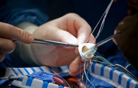 Eerste aortaklep implantatie in CMC