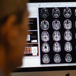 Maastrichtse wetenschapper ontdekt manier om risico op alzheimer te signaleren